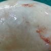 نقيب أطباء الأقصر يستأصل “ورم” حجمه 10 سم بالمنظار عبر فتحة قطرها 0.5 سم