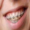 طبيب أسنان: التقويم المتحرك ليس حلا لعلاج بروز الأسنان