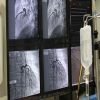 باحثون أمريكيون: أداة جديدة لتقليل مضاعفات القسطرة القلبية  