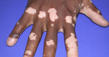 العلاج الضوئى الأفضل فى القضاء على البهاق