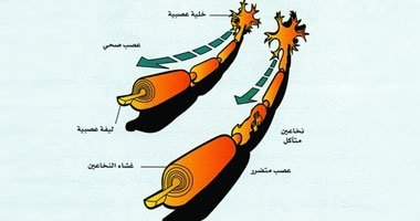 باحثون أمريكيون يتوصلون لعلاج التصلب العصبى المتعدد بالخلايا الجذعية