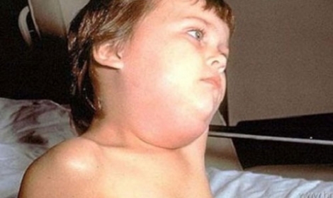 التعليم: اكتشاف إصابات جديدة بـالغدة النكافية بالمدارس